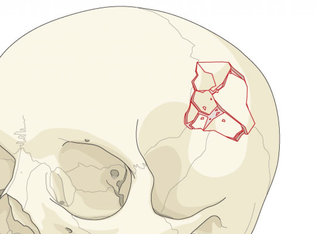 Череп разрыв. Многооскольчатый перелом костей свода черепа. Оскольчатый перелом перелом черепа. Вдавленный перелом костей свода черепа. Оскольчатый перелом основания черепа.